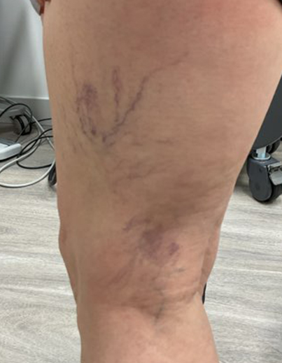 Spider Veins — Left Leg - Before